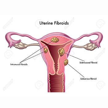 Miomas uterinos – miomectomía – metrorragia – sangramiento del útero – menstruación anormal