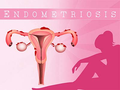 Endometriosis – dolor pelviano – dismenorrea 